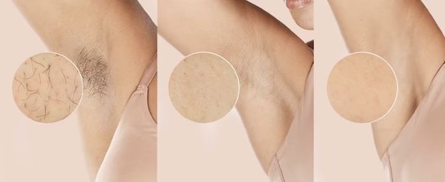 👩‍🦰 Philips Lumea Advanced SC1994 Haarentfernungsgerät für 167,31€ (statt 241€)